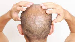 Berita Terkini tentang Terapi Sel Punca untuk Rambut